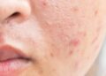 4 How to Whiten Acne Scars on the Face Quickly and Easily