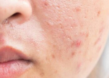 4 How to Whiten Acne Scars on the Face Quickly and Easily