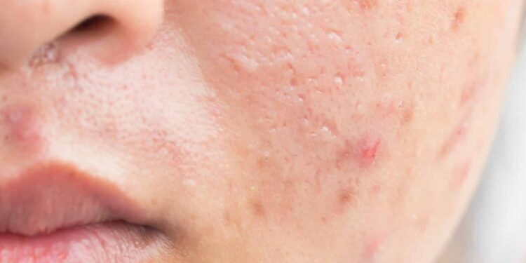 4 How to Whiten Acne Scars on the Face Quickly and Easily